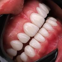 کامپوزیت دندان،لمینیت،روکش،عصب کشی|خدمات آرایشگری و زیبایی|تهران, سعادت‌آباد|دیوار