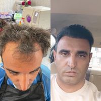 کاشت مو تبریز|خدمات آرایشگری و زیبایی|مرند, |دیوار