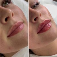 لیزرمو بوتاکس ژل هایفو فیشیال رفع سیاهی زیرچشم|خدمات آرایشگری و زیبایی|تهران, هفت حوض|دیوار