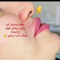 ژل لب،زاویه،بوتاکس،فیلر بینی،مزوسر غبغب|خدمات آرایشگری و زیبایی|تهران, شهران شمالی|دیوار