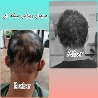 تزریق ژل،بوتاکس،بلفاروپلاستی ،اندولیفت|خدمات آرایشگری و زیبایی|تهران, اختیاریه|دیوار