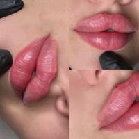 ژل لب فیلر لبروسی بوتاکس مزو جوانساز ژل گونه زاویه|خدمات آرایشگری و زیبایی|کرج, گوهردشت|دیوار