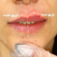 تزریق فیلر ژل توسط پزشک در کلینیک زیبایی|خدمات آرایشگری و زیبایی|تهران, تهران‌سر|دیوار