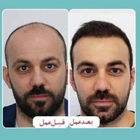 بلفارو پلاستی، کاشت مو، ابرو و هایفوتراپی هفت بعدی|خدمات آرایشگری و زیبایی|تهران, ستارخان|دیوار