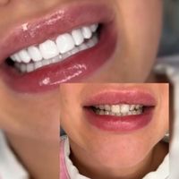 کامپوزیت دندان فقط 8500هر فک نقد و چک|خدمات آرایشگری و زیبایی|رشت, گلسار|دیوار