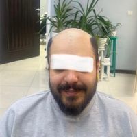 پروتز مو. نصب پروتز  تعویض چسب کوتاهی مو|خدمات آرایشگری و زیبایی|تهران, دردشت|دیوار