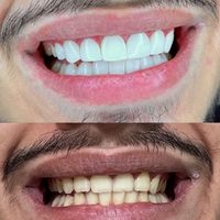 مدل کامپوزیت دندان|خدمات آرایشگری و زیبایی|تهران, هاشمی|دیوار
