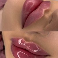 تزریق لب روسی/فیلر بادی/بوتاکس/مزوژل/prp|خدمات آرایشگری و زیبایی|تهران, تهرانپارس غربی|دیوار