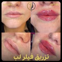 فیلر لب زاویه سازی صورت بوتاکس فیلر زیرچشم|خدمات آرایشگری و زیبایی|تهران, سعادت‌آباد|دیوار