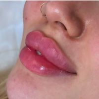 تزریق لب روسی/فیلر بادی/بوتاکس/مزوژل/prp|خدمات آرایشگری و زیبایی|تهران, تهرانپارس غربی|دیوار