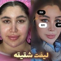 تنها متد لیفت شقیقه و چشم گربه ای بدون جراحی|خدمات آرایشگری و زیبایی|تهران, خزانه|دیوار