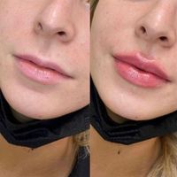 لیزرمو بوتاکس ژل هایفو فیشیال رفع سیاهی زیرچشم|خدمات آرایشگری و زیبایی|تهران, هفت حوض|دیوار
