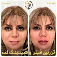 فیلر لب زاویه سازی صورت بوتاکس فیلر زیرچشم|خدمات آرایشگری و زیبایی|تهران, سعادت‌آباد|دیوار