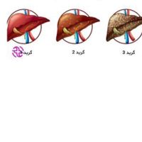 درمان کبدچرب|آرایشی، بهداشتی، درمانی|تهران, عبدل‌آباد|دیوار