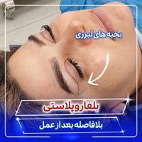 بلفاروپلاستی توسط جراح و متخصص چشم|خدمات آرایشگری و زیبایی|تهران, صادقیه|دیوار