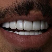 کامپوزیت دندان،لمینیت،روکش،عصب کشی|خدمات آرایشگری و زیبایی|تهران, شهرک غرب|دیوار