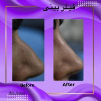 تخفیف بوتاکس،فیلر،هایفو،کربوکسی،مزوژل|خدمات آرایشگری و زیبایی|تهران, سازمان برنامه|دیوار