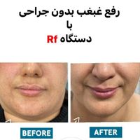 ژل لب گونه چانه لیزر رفع لک بوتاکس لاغری|خدمات آرایشگری و زیبایی|تهران, هفت حوض|دیوار