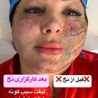 جشوارهvip ساکشن غبغب‌بلفاروپلاستی‌نخ‌بوکال‌فت‌ ژل|خدمات آرایشگری و زیبایی|تهران, شهرک غرب|دیوار