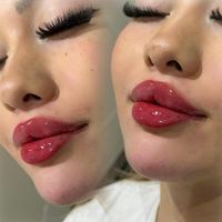 مدل ژل لب روسی نخ انزیم فیلر بوتاکس زاویه فیلربادی|خدمات آرایشگری و زیبایی|تهران, تهرانپارس غربی|دیوار