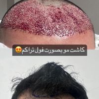 لیزر فیلر ژل بوتاکس فشیال کاشت مو کاشت ابرو|خدمات آرایشگری و زیبایی|تهران, شهرک ولیعصر|دیوار