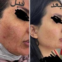 چاقی صورت تضمینی بادستگاه تخصصی و پیشرفته فقط خانم|خدمات آرایشگری و زیبایی|اصفهان, خانه اصفهان|دیوار