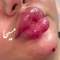 تزریق ژل لب گونه چونه زوایه بوتاکس مزو مو آنزیم|خدمات آرایشگری و زیبایی|تهران, امام سجاد(ع)|دیوار