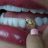 جشنواره کامپوزیت لمینیت روکش عصب ونیر ترمیم بریدج|خدمات آرایشگری و زیبایی|تهران, هفت حوض|دیوار
