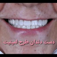 دست دندان طرح لمینیت|خدمات آرایشگری و زیبایی|تهران, تهرانپارس غربی|دیوار