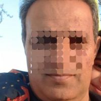 کاشت مو و ابرو به روش شیراز در اصفهان(اقساطی)|خدمات آرایشگری و زیبایی|اصفهان, مرداویج|دیوار