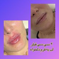 لیزر فیلر ژل بوتاکس فشیال کاشت مو کاشت ابرو|خدمات آرایشگری و زیبایی|تهران, شهرک ولیعصر|دیوار