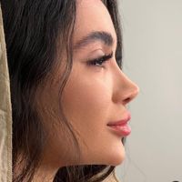 جراحی زیبایی، بینی|خدمات آرایشگری و زیبایی|تهران, شهرک شریعتی|دیوار