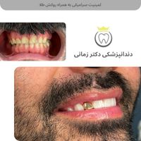 ایمپلنت و لمینیت دیجیتال با شرایط پرداخت|خدمات آرایشگری و زیبایی|تهران, امیریه|دیوار