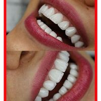 کامپوزیت دندان/لمینیت/دندانپزشکی/ترمیم/پالیش|خدمات آرایشگری و زیبایی|تهران, جردن|دیوار