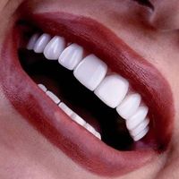 دندانپزشکی کامپوزیت/لمینت/روکش/ایمپلنت/عصبکشی|خدمات آرایشگری و زیبایی|تهران, سلسبیل|دیوار