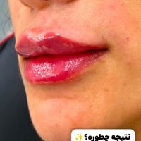 تزریق فیلر ژل توسط پزشک در کلینیک زیبایی|خدمات آرایشگری و زیبایی|تهران, تهران‌سر|دیوار