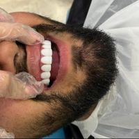 کامپوزیت دندان فقط 8500هر فک نقد و چک|خدمات آرایشگری و زیبایی|رشت, گلسار|دیوار