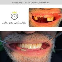 ایمپلنت و لمینیت دیجیتال با شرایط پرداخت|خدمات آرایشگری و زیبایی|تهران, امیریه|دیوار