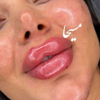 تزریق ژل لب گونه چونه زوایه بوتاکس مزو مو آنزیم|خدمات آرایشگری و زیبایی|تهران, امام سجاد(ع)|دیوار