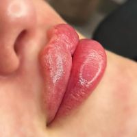 مدل ژل لب روسی نخ انزیم فیلر بوتاکس زاویه فیلربادی|خدمات آرایشگری و زیبایی|تهران, تهرانپارس غربی|دیوار