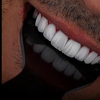 جشنواره ایمپلنت .اوردنچر  نقد. اقساط|خدمات آرایشگری و زیبایی|تهران, دانشگاه علم و صنعت|دیوار