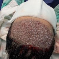 کاشت مو ابرو و ریش بدون درد با پایین|خدمات آرایشگری و زیبایی|تهران, جردن|دیوار