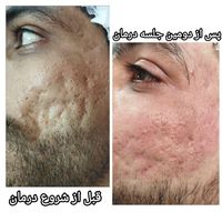 **درمان تخصصی و تضمینی اسکار آکنه**|خدمات آرایشگری و زیبایی|اصفهان, مولوی|دیوار