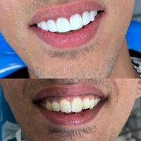مدل کامپوزیت دندان|خدمات آرایشگری و زیبایی|تهران, هاشمی|دیوار