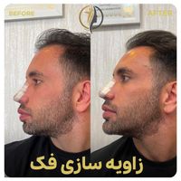 فیلر لب زاویه سازی صورت بوتاکس فیلر زیرچشم|خدمات آرایشگری و زیبایی|تهران, سعادت‌آباد|دیوار