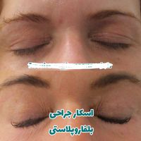 لیزر جای بخیه جراحی اسکار آکنه سوختگی منافذ باز|خدمات آرایشگری و زیبایی|تهران, شهرک غرب|دیوار