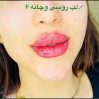 ژل لب،زاویه،بوتاکس،فیلر بینی،مزوسر غبغب|خدمات آرایشگری و زیبایی|تهران, شهران شمالی|دیوار