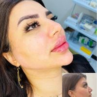 ژل لب،زاویه،بوتاکس،فیلر بینی،مزوسر غبغب|خدمات آرایشگری و زیبایی|تهران, شهران شمالی|دیوار