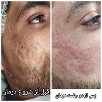 **درمان تخصصی و تضمینی اسکار آکنه**|خدمات آرایشگری و زیبایی|اصفهان, مولوی|دیوار