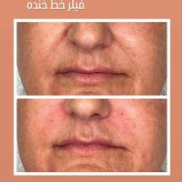 میکروبلیدینگ و میکروپیگمنتیشن صورت الی|خدمات آرایشگری و زیبایی|تهران, هفت چنار|دیوار